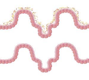 sindrom propusnih crijeva leaky gut prirodno liječenje - prirodni lijekovi za hiperpermeabilnost
